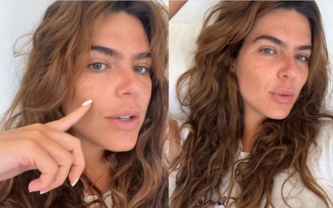 Mariana Goldfarb mostrou seu melasma na face nesta terça-feira (19), e abriu o coração sobre como se sente com as manchas escuras na pele. (Foto: Instagram)