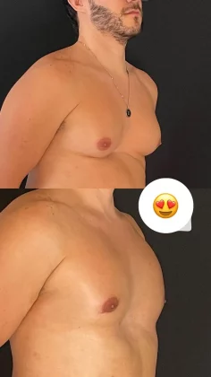 O marido de Viih Tube postou uma série de fotos do antes e depois do procedimento para retirada de gordura localizada. (Foto: Instagram)