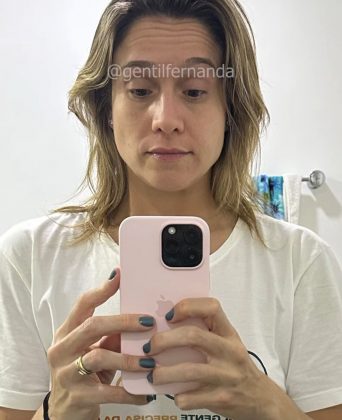 uma condição médica que afeta os músculos faciais, causando sintomas como dormência e dificuldade para movimentar o rosto. (Foto: Instagram)