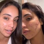 Vanessa Lopes desabafa sobre acne e saúde mental. (Foto Instagram)