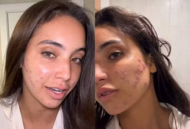 Vanessa Lopes desabafa sobre acne e saúde mental. (Foto Instagram)