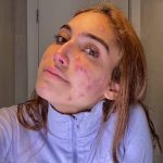 Sugestões para melhorar o texto: 1. Introdução mais impactante: Opção 1: A influenciadora Vanessa Lopes usou suas redes sociais para fazer um desabafo emocionante e sincero sobre sua luta contra a acne, mostrando um lado mais vulnerável e humano. Opção 2: Em um momento de grande sinceridade, Vanessa Lopes, ex-BBB, abriu seu coração para os seguidores e revelou os desafios que enfrenta com a acne, quebrando o estereótipo de perfeição nas redes sociais. 2. Desenvolvimento mais detalhado: Citar frases marcantes: Incluir frases-chave do desabafo de Vanessa para fortalecer o impacto emocional do texto. Explorar os sentimentos: Descrever com mais detalhes os sentimentos de Vanessa, como a insegurança, a frustração e a raiva. Contextualizar a situação: Explicar o contexto em que o desabafo aconteceu (por exemplo, se ela estava se preparando para algum evento ou se a acne piorou recentemente). 3. Analisar o impacto do desabafo: Repercussão nas redes sociais: Descrever as reações dos seguidores, como mensagens de apoio, compartilhamentos e comentários positivos. Importância do desabafo: Destacar a importância de personalidades públicas como Vanessa usarem sua voz para falar sobre temas como saúde mental e autoestima. Quebrar tabus: Enfatizar como o desabafo de Vanessa contribui para quebrar tabus e normalizar a discussão sobre problemas de pele. 4. Conclusão mais reflexiva: Chamada para ação: Incentivar os leitores a serem mais compreensivos e empáticos com pessoas que enfrentam problemas de pele. Mensagem de esperança: Transmitir uma mensagem de esperança e mostrar que é possível superar os desafios da acne. Exemplo de texto revisado: Em um desabafo emocionante nas redes sociais, a influenciadora Vanessa Lopes abriu seu coração para os seguidores e revelou a luta diária que enfrenta contra a acne. (Foto Instagram)