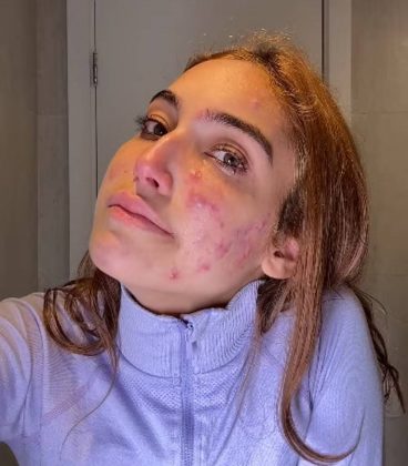 Sugestões para melhorar o texto: 1. Introdução mais impactante: Opção 1: A influenciadora Vanessa Lopes usou suas redes sociais para fazer um desabafo emocionante e sincero sobre sua luta contra a acne, mostrando um lado mais vulnerável e humano. Opção 2: Em um momento de grande sinceridade, Vanessa Lopes, ex-BBB, abriu seu coração para os seguidores e revelou os desafios que enfrenta com a acne, quebrando o estereótipo de perfeição nas redes sociais. 2. Desenvolvimento mais detalhado: Citar frases marcantes: Incluir frases-chave do desabafo de Vanessa para fortalecer o impacto emocional do texto. Explorar os sentimentos: Descrever com mais detalhes os sentimentos de Vanessa, como a insegurança, a frustração e a raiva. Contextualizar a situação: Explicar o contexto em que o desabafo aconteceu (por exemplo, se ela estava se preparando para algum evento ou se a acne piorou recentemente). 3. Analisar o impacto do desabafo: Repercussão nas redes sociais: Descrever as reações dos seguidores, como mensagens de apoio, compartilhamentos e comentários positivos. Importância do desabafo: Destacar a importância de personalidades públicas como Vanessa usarem sua voz para falar sobre temas como saúde mental e autoestima. Quebrar tabus: Enfatizar como o desabafo de Vanessa contribui para quebrar tabus e normalizar a discussão sobre problemas de pele. 4. Conclusão mais reflexiva: Chamada para ação: Incentivar os leitores a serem mais compreensivos e empáticos com pessoas que enfrentam problemas de pele. Mensagem de esperança: Transmitir uma mensagem de esperança e mostrar que é possível superar os desafios da acne. Exemplo de texto revisado: Em um desabafo emocionante nas redes sociais, a influenciadora Vanessa Lopes abriu seu coração para os seguidores e revelou a luta diária que enfrenta contra a acne. (Foto Instagram)