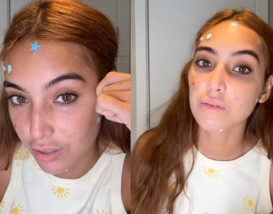 Vanessa Lopes compartilha luta contra acne: "Afeta a minha autoestima" (Foto Instagram)