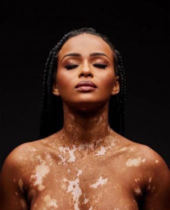 Assim como Natália Deodato, confira famosos que têm vitiligo. (Foto Instagram)