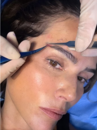 Deborah Secco faz transplante de sobrancelha. (Foto: Instagram)