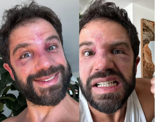 Após luta com Popó, Duda Nagle relata dificuldades até para entrar na academia: "Nem a catraca me reconheceu" (Foto: Instagram)