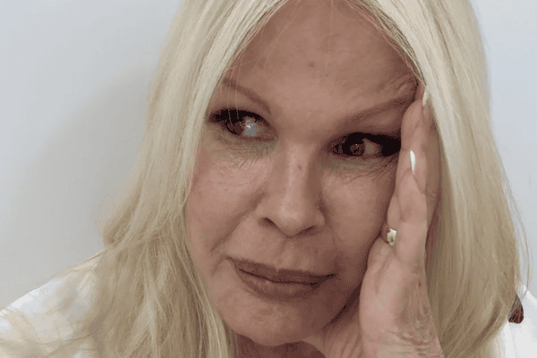 Monique Evans relata dificuldade com banco após cirurgia no rosto