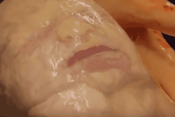 Bebê nasce empelicada durante parto de gêmeos e cena emociona