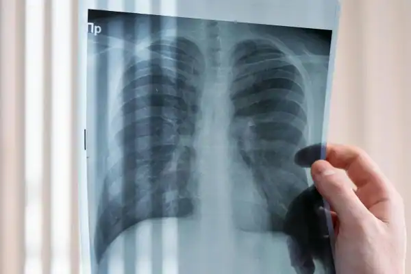 Diagnóstico tardio e tratamento inadequado elevam mortalidade por câncer de pulmão