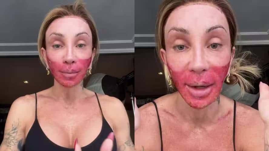Maya Massafera surge com rosto vermelho após peeling e revela: “Hoje, é o pior dia” (Foto: Instagram)