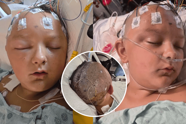 Mãe relata desespero após filho fraturar o crânio em acidente de patinete elétrico: “Poderia morrer”