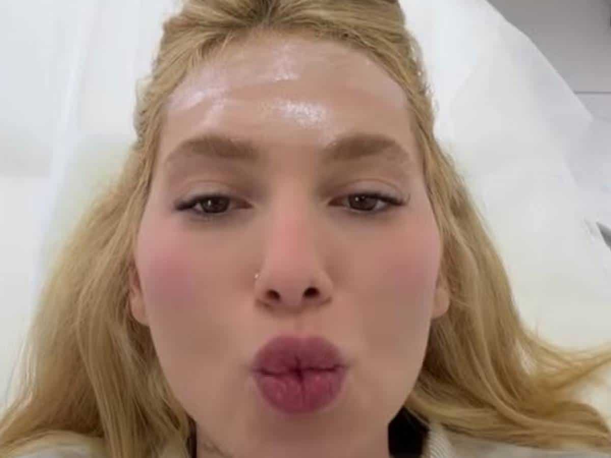 O procedimento com 31 agulhadas feito por Virginia Fonseca para tratar enxaqueca (Foto: Instagram)