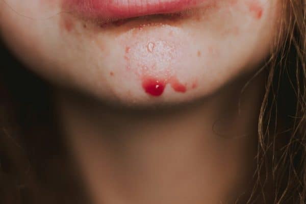 Ela achou que era uma simples espinha, mas descoberta no rosto após 19 anos assustou