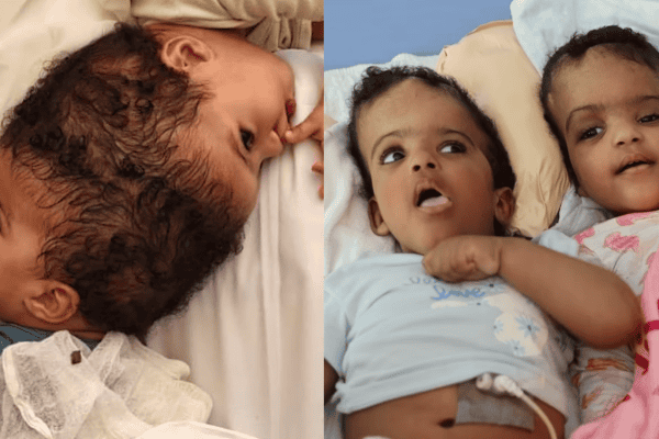 Gêmeas siamesas são separadas após cirurgia de mais de 24 horas